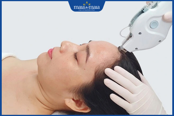 thực hiện cấy meso không kim