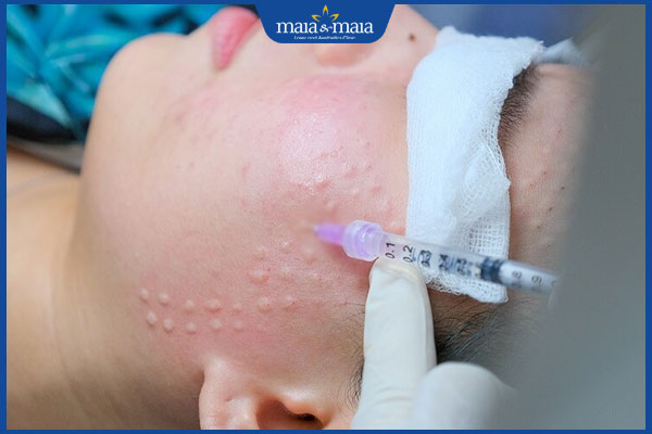 Bí quyết cải thiện khuôn mặt già trước tuổi và ngăn ngừa lão hóa 5 tiêm meso theo đường