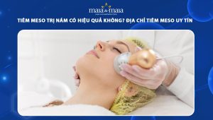 Tiêm meso trị nám có hiệu quả không? Địa chỉ tiêm meso uy tín 87 tiêm meso trị nám