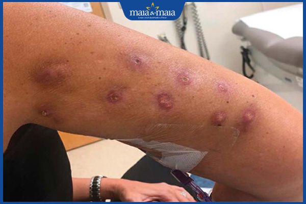 Tiêm meso giảm béo có tốt không? Rủi ro và các lưu ý cần ghi nhớ 5 biến chứng meso giảm béo