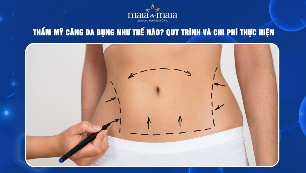 căng da bụng
