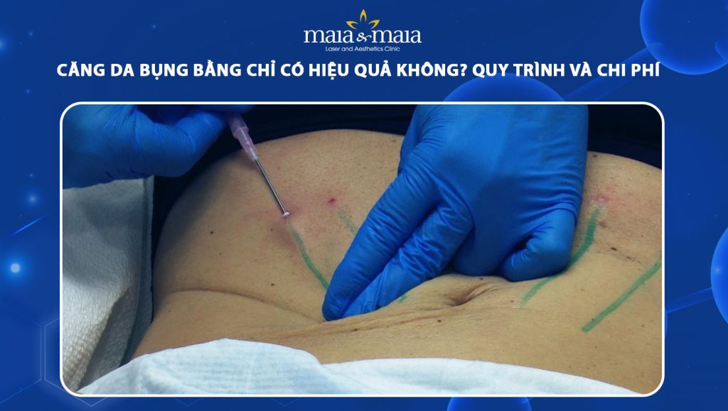 căng da bụng bằng chỉ