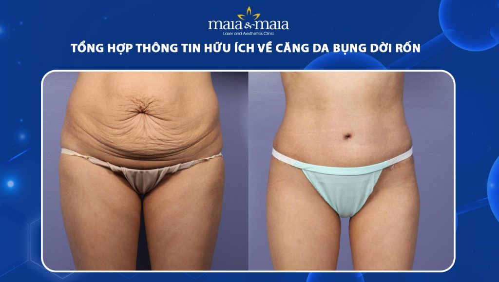 căng da bụng dời rốn