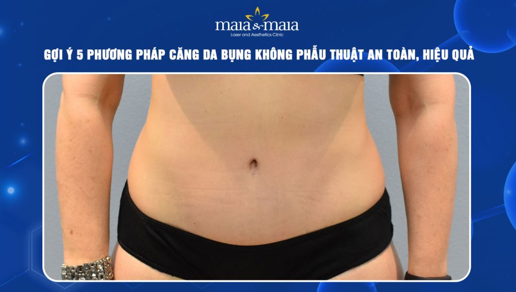 Căng da bụng không phẫu thuật