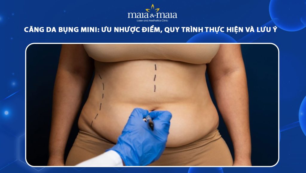 căng da bụng mini