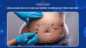 căng da bụng nội soi