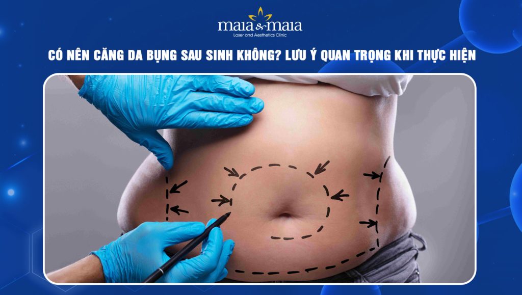 Căng da bụng sau sinh