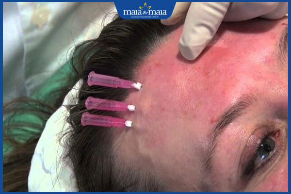 căng da trán bằng chỉ