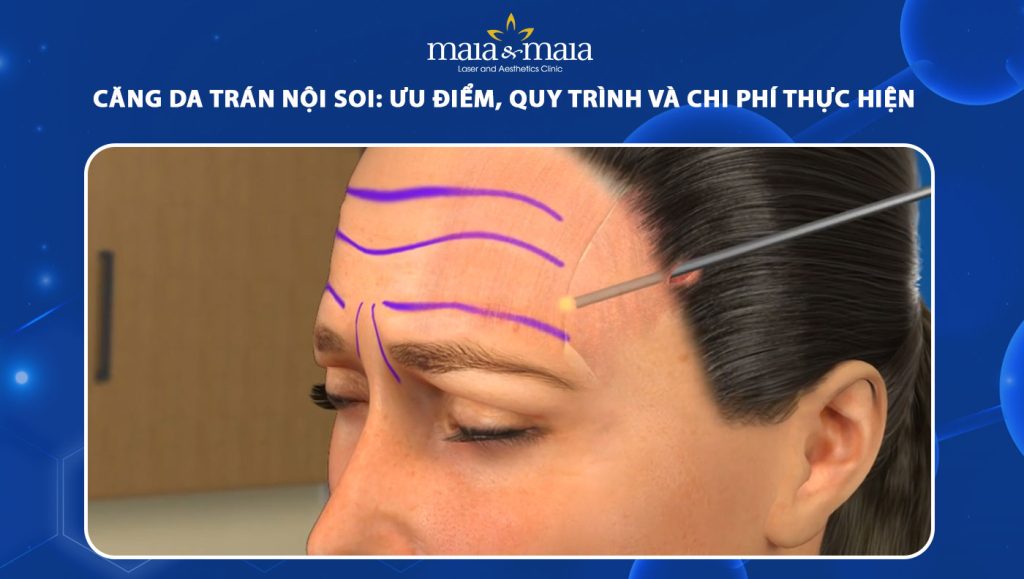căng da trán nội soi
