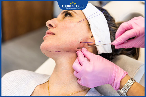 cấy chỉ căng trán