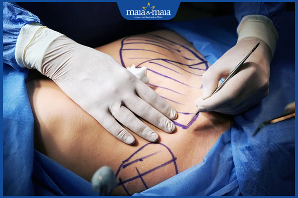 chuẩn bị căng da bụng bằng chỉ