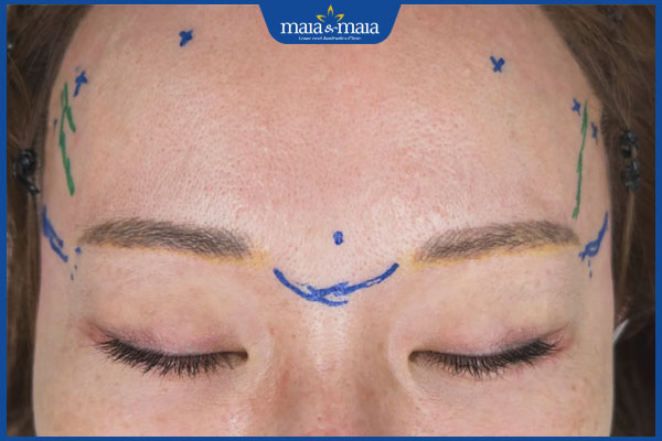 chuẩn bị căng da trán