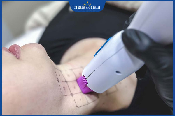 Điểm danh 10+ cách xóa nếp nhăn giúp làn da trẻ mãi 5 công nghệ thermage trẻ hoá vùng cổ