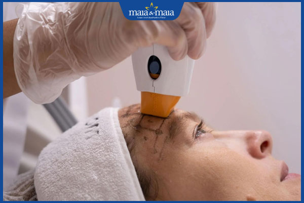 Công nghệ Thermage trẻ hóa tốt không? Quy trình và chi phí thực hiện 6 công nghệ trẻ hoá da thermage