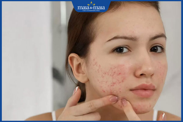 Tổng hợp các cách tẩy lông nách bằng dầu dừa an toàn tại nhà 4 da bị mụn