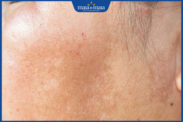 6 sai lầm trong điều trị rám má khiến da ngày càng sạm hơn 2 da sạm màu