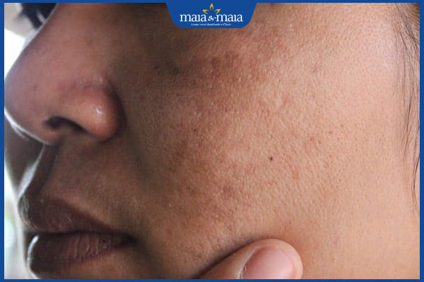 Mài da vi điểm: Lợi ích, đối tượng phù hợp, lưu ý cần ghi nhớ 3 da xỉn màu