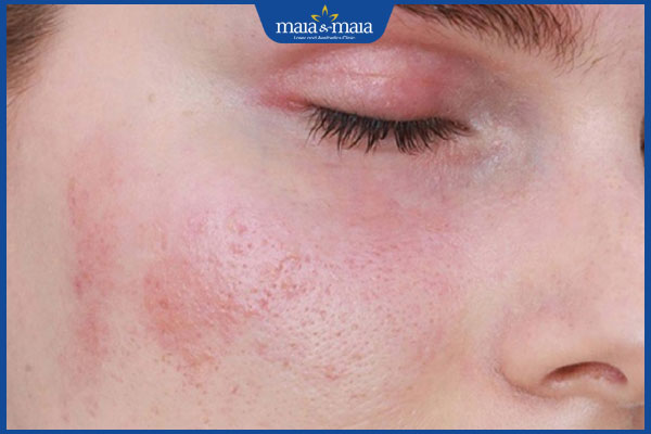 Thermage FLX: Nâng cơ, xóa nhăn, trẻ hóa da chỉ sau 1 liệu trình 3 đỏ da sau thermage