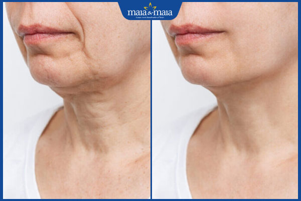 Thermage FLX: Nâng cơ, xóa nhăn, trẻ hóa da chỉ sau 1 liệu trình 5 hiệu quả thermage