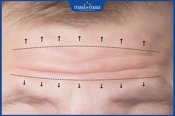 kỹ thuật căng da trán