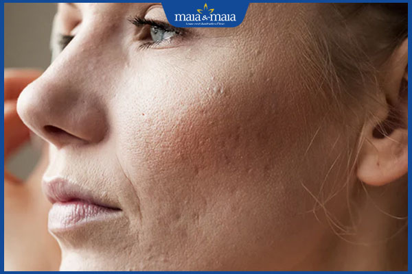 làn da sần sùi lỗ chân lông to