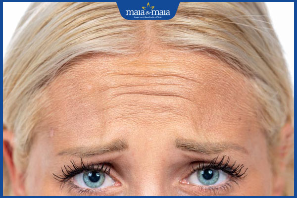 Tiêm botox căng da mặt hiệu quả không? Địa chỉ thực hiện uy tín 3 nếp nhăn trán