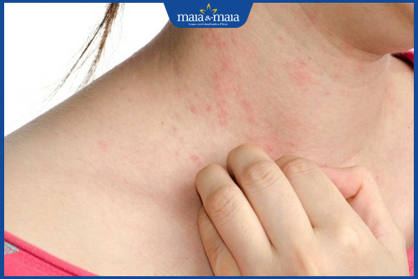 người bị dị ứng