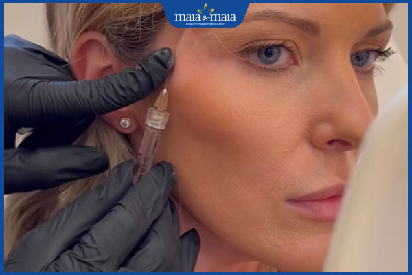 Căng da thái dương có đau không? Hiệu quả kéo dài bao lâu? 3 người nên thực hiện căng da thái dương