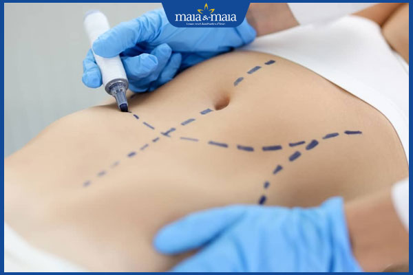 phẫu thuật căng da bụng