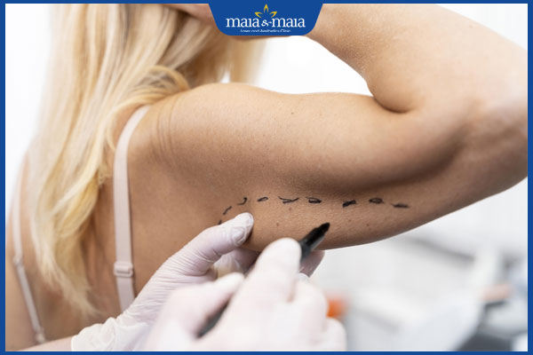 phẫu thuật căng da nách