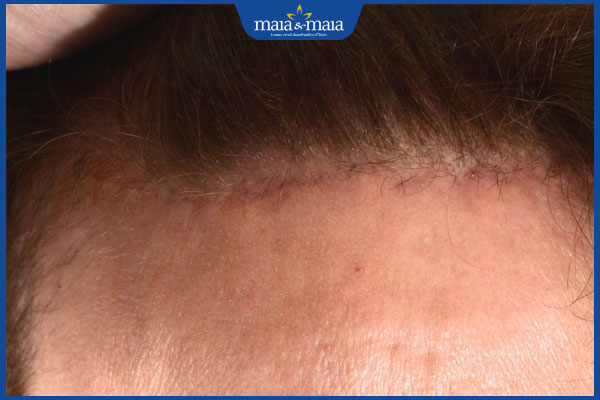 sẹo căng da trán