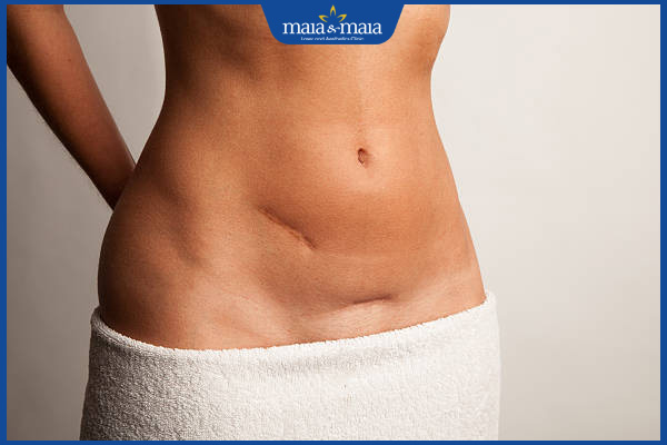 sẹo sau căng da bụng