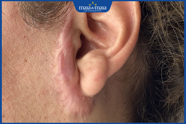 sẹo sau căng da mặt