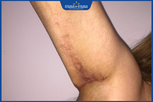 sẹo sau căng da nách