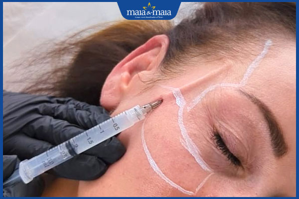 Căng da thái dương có đau không? Hiệu quả kéo dài bao lâu? 2 thực hiện căng da thái dương