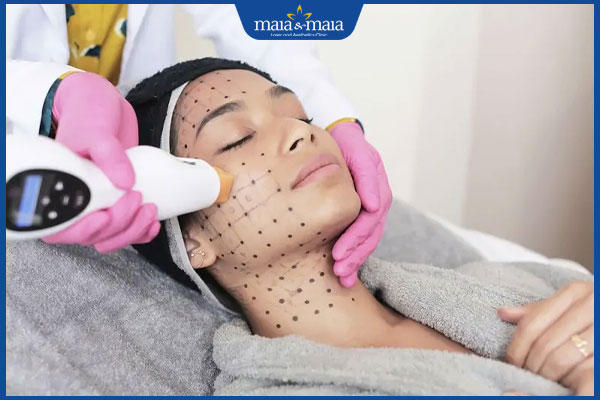 Thermage FLX: Nâng cơ, xóa nhăn, trẻ hóa da chỉ sau 1 liệu trình 2 thực hiện trẻ hóa thermage flx