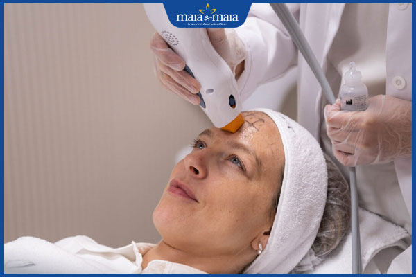 Công nghệ Thermage trẻ hóa tốt không? Quy trình và chi phí thực hiện 5 tiến hành thermage