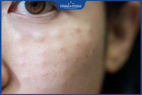 tình trạng nổi u hạt sau tiêm meso