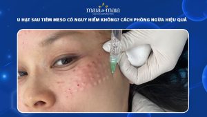 U hạt sau tiêm meso có nguy hiểm không? Hướng dẫn cách phòng ngừa an toàn, hiệu quả 36 u hạt sau tiêm meso