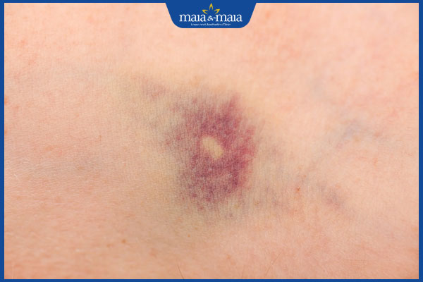 Trẻ hóa da bằng PRP có tác dụng gì? Ai nên và không nên thực hiện? 5 bầm tím da