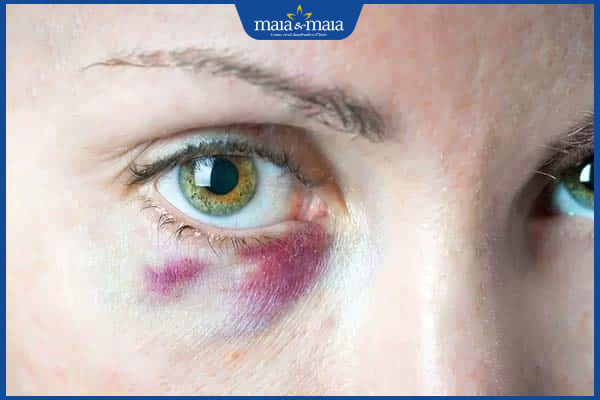 bầm tím sau tiêm filler bọng mắt