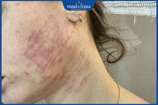 Nâng cơ HIFU giá bao nhiêu cho 1 liệu trình? Lưu ý khi thực hiện 3 bỏng da sau hifu