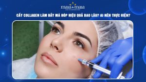 Cấy collagen làm đầy má hóp hiệu quả bao lâu? Ai nên thực hiện? 58 Cấy collagen làm đầy má hóp