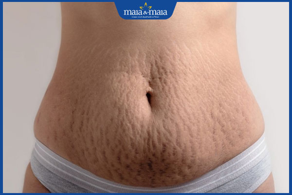 Trẻ hóa da toàn thân bằng phương pháp nào là hiệu quả nhất?  3 da bị rạn sau sinh