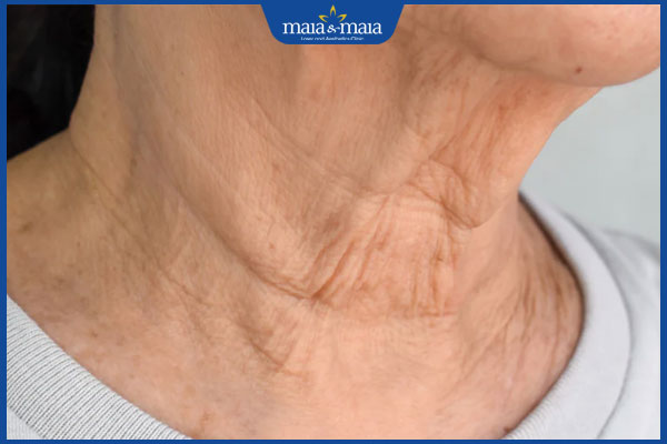 Nếp nhăn ở cổ do đâu? Gợi ý phương pháp xóa nhăn vùng cổ hiệu quả 2 da cổ đang lão hóa