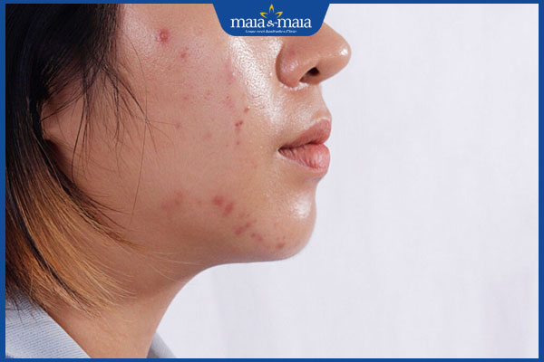 Tiêm meso căng bóng da có hiệu quả không? Địa chỉ thực hiện an toàn 3 da dầu mụn