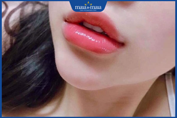 Tổng hợp các dáng môi tiêm filler đẹp được ưa chuộng nhất 8 dáng môi baby