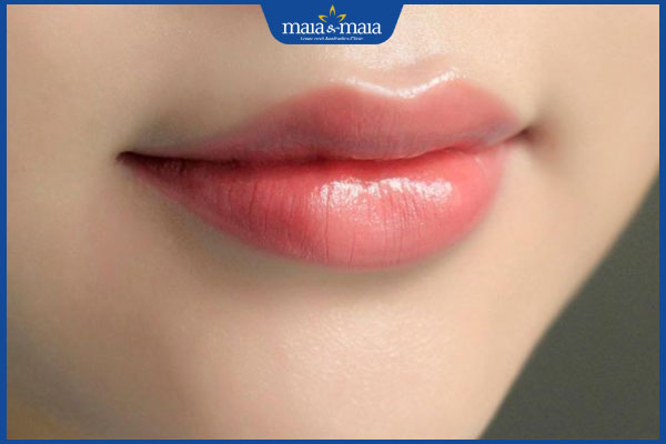 Tổng hợp các dáng môi tiêm filler đẹp được ưa chuộng nhất 5 dáng môi cherry