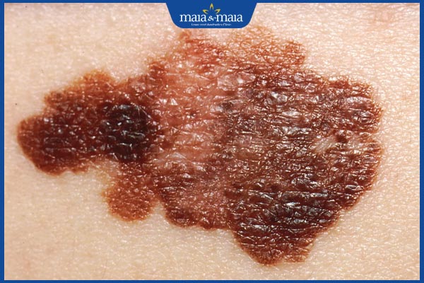 Phục hồi và điều trị lão hóa da do ánh nắng như thế nào? 3 dấu hiệu ung thư da