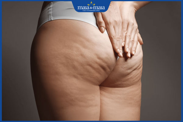 hai bên mông lệch nhau